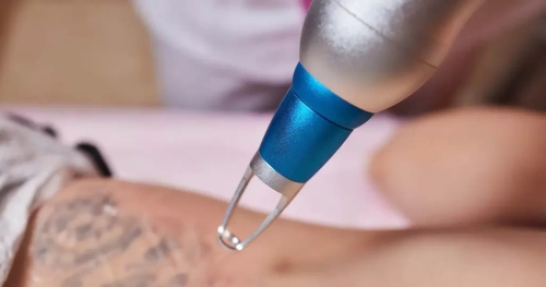 Laser Tattoo Removal