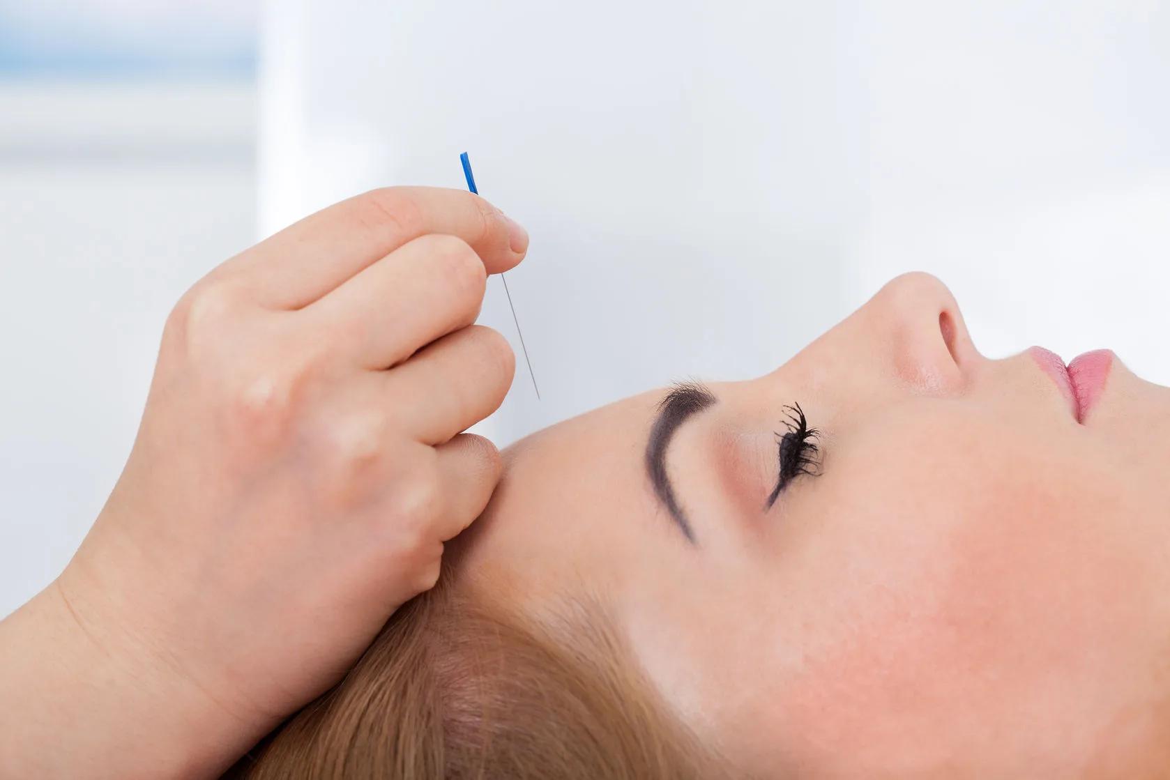 acupuncture facts and benefits