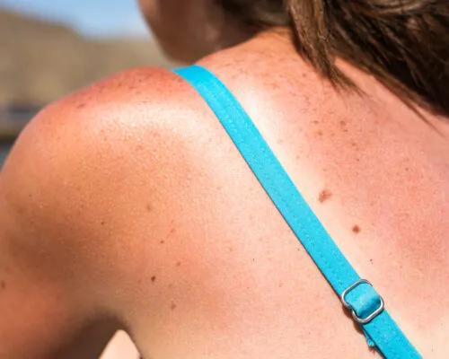 Sunburn Relief: 5 Easy Ways to Heal Faster