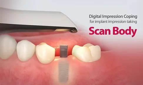 Exocad Premium DentalCAD Implant Library Ingrandisci immagine