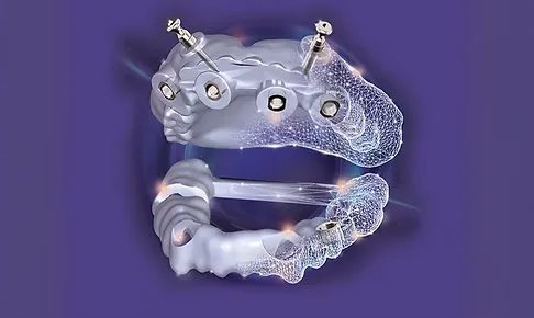 Premium Exoplan Implant Library Ingrandisci immagine