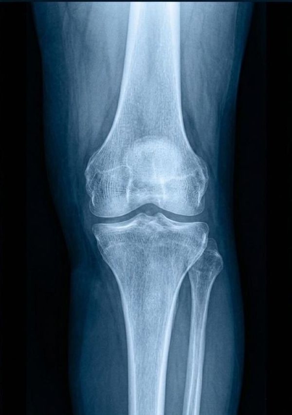 Rodilla