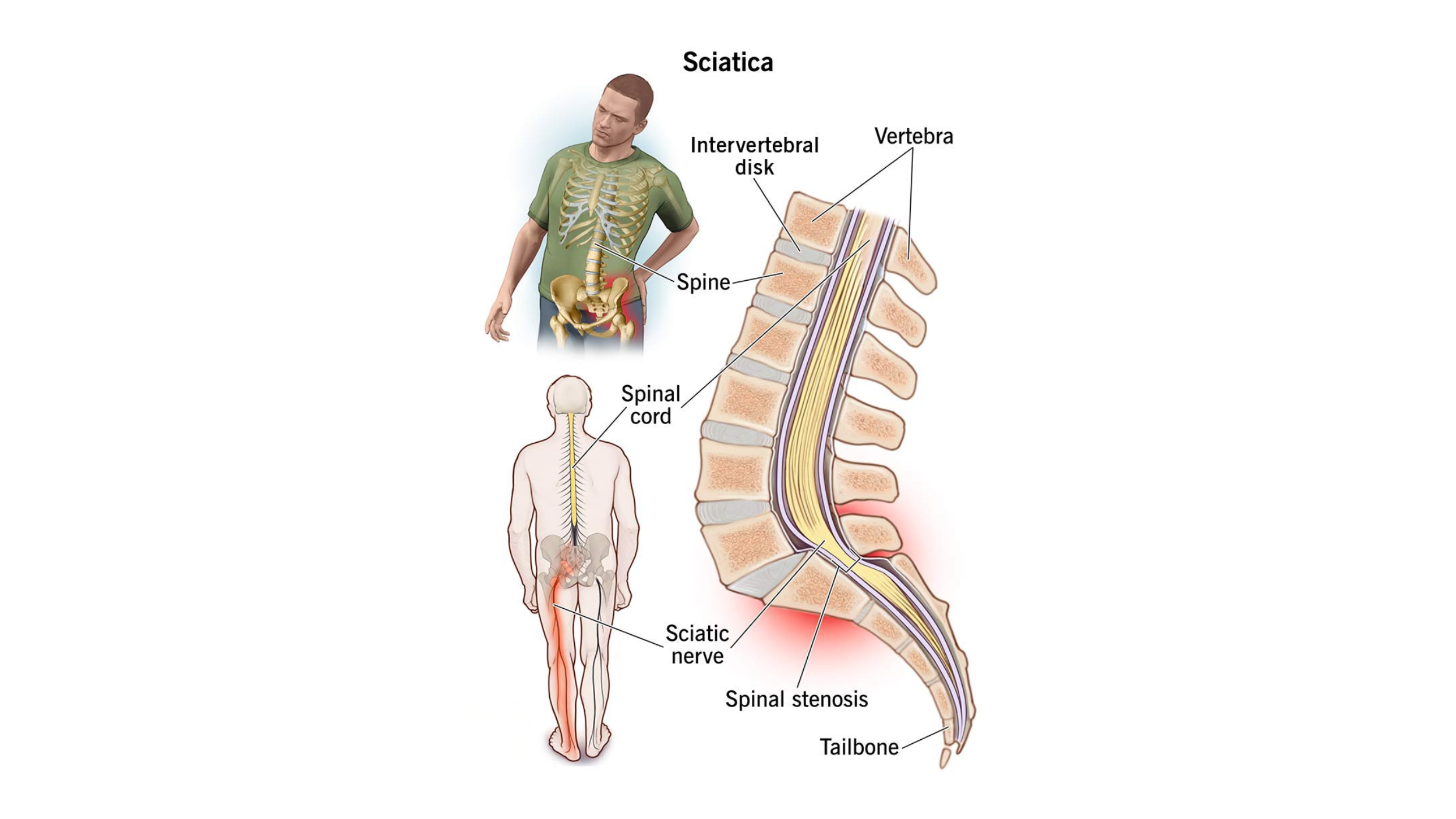 Early Signs of Sciatica