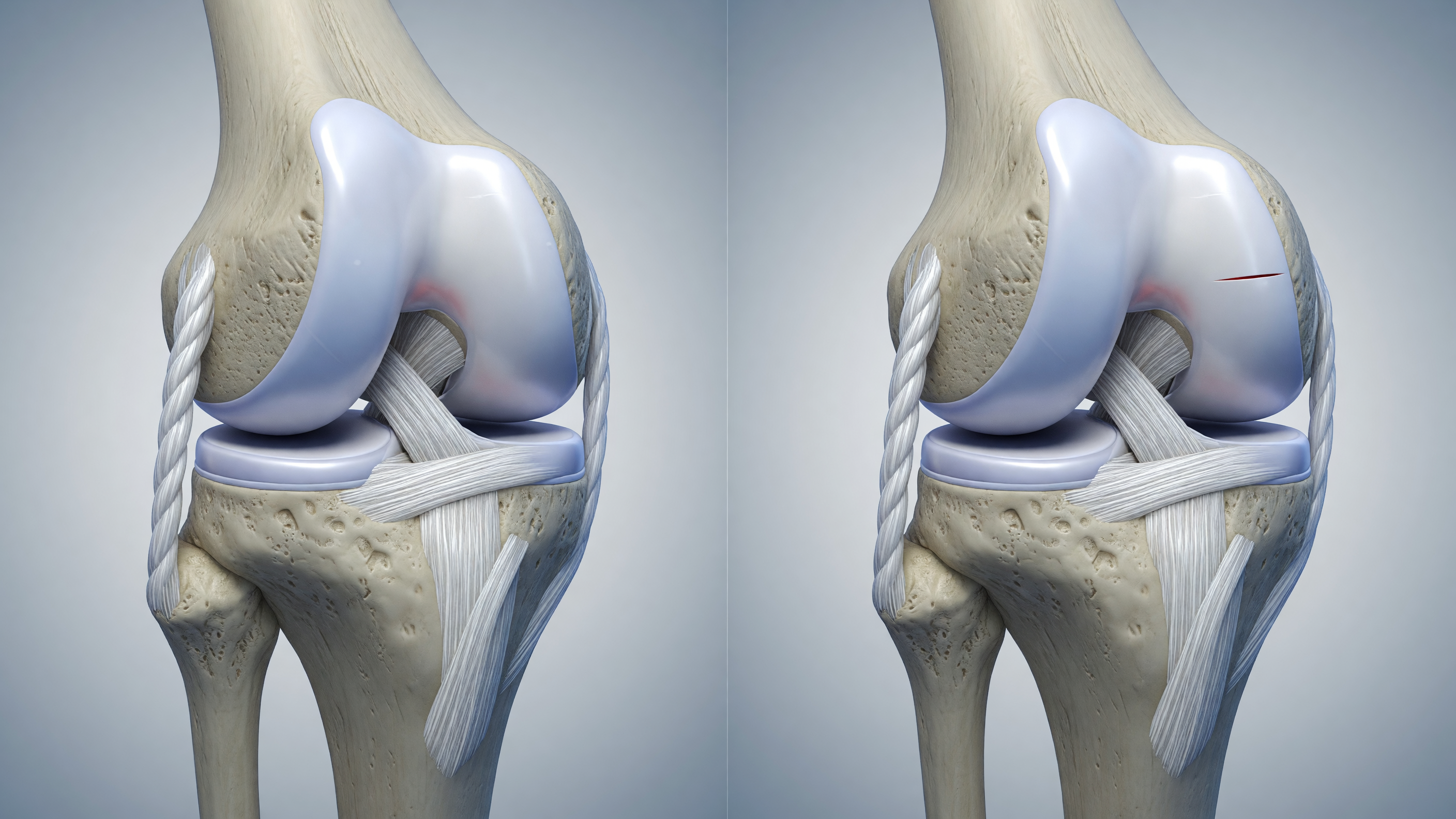 Comparison illustration showing meniscus tear vs ACL tear anatomy in the knee joint