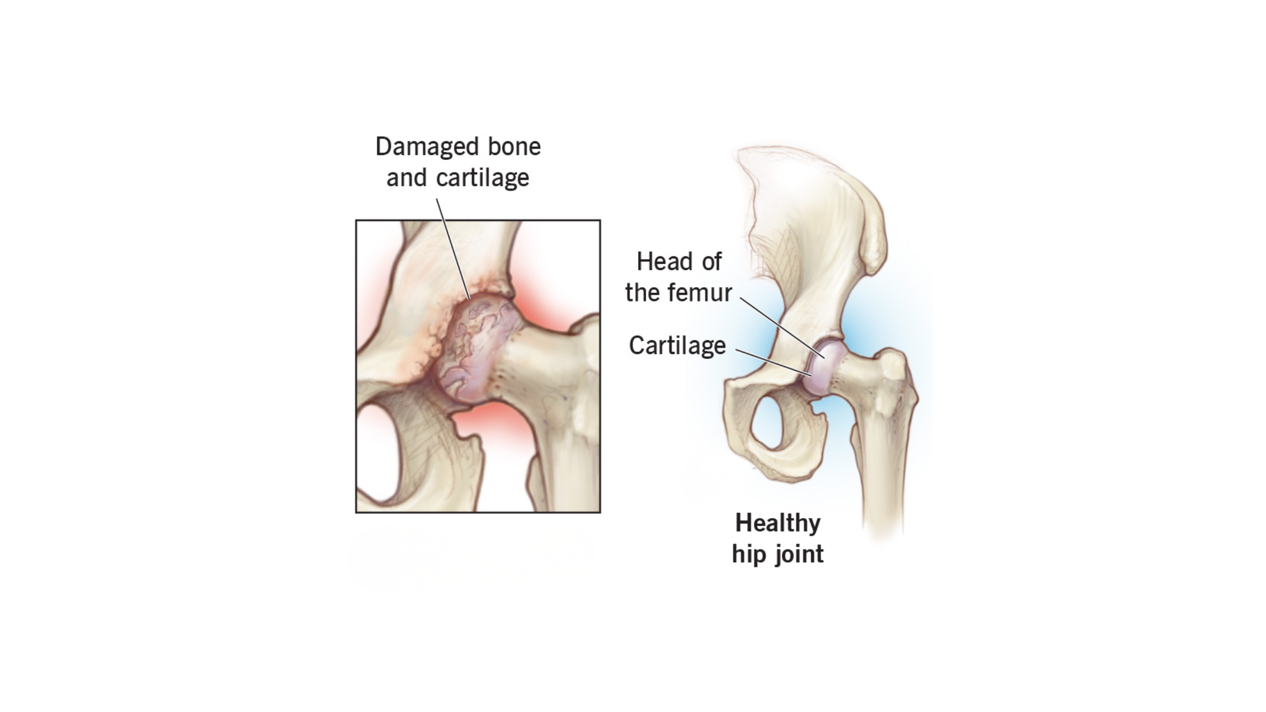 Causes of Hip Joint Damage