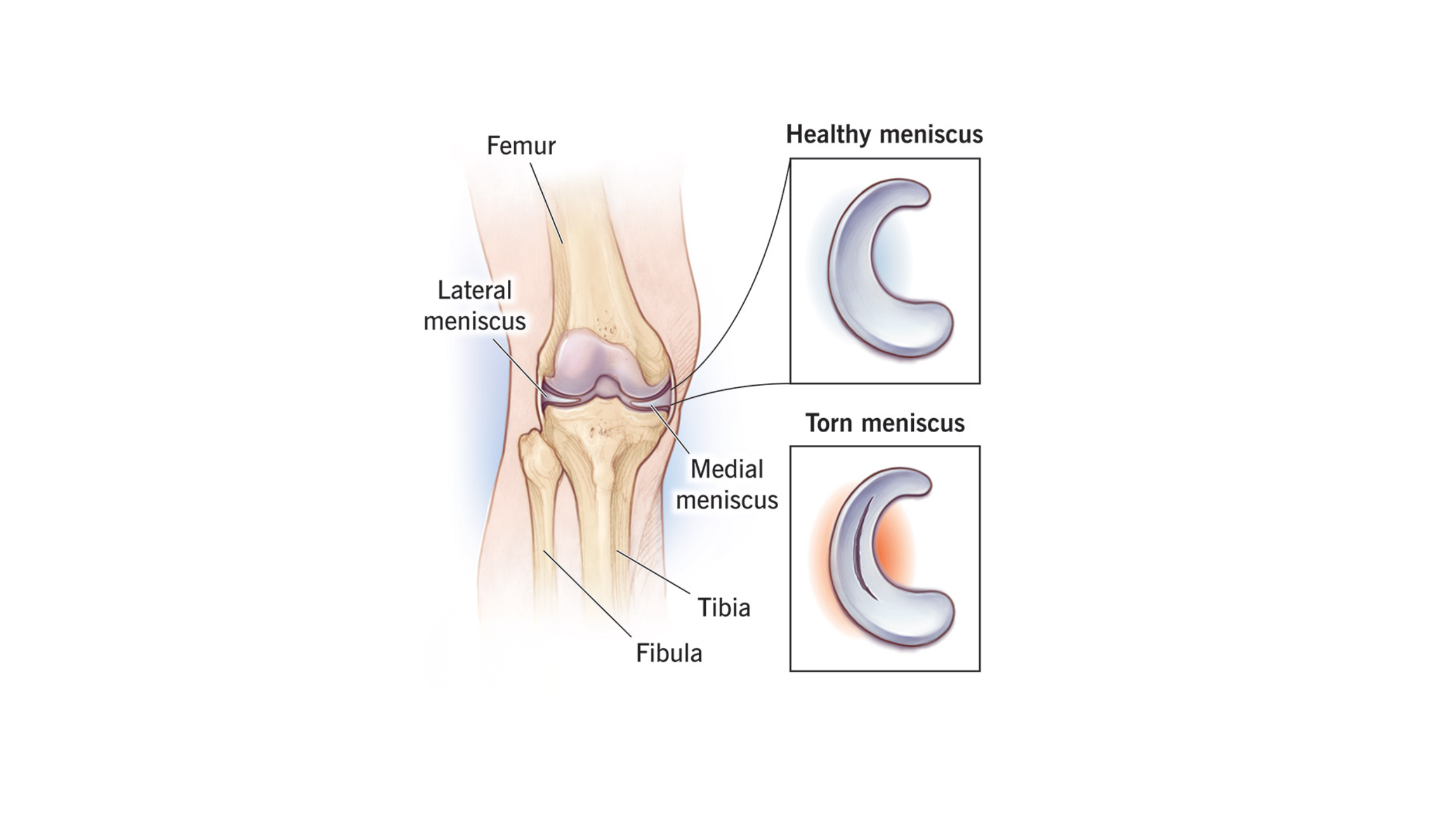 Meniscus Tear