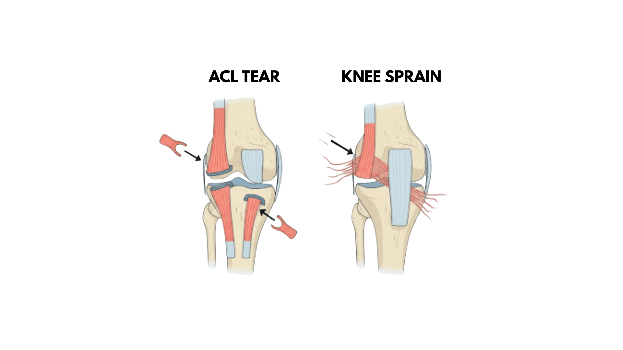 ACL tear vs knee sprain comparison showing ligament injury differences