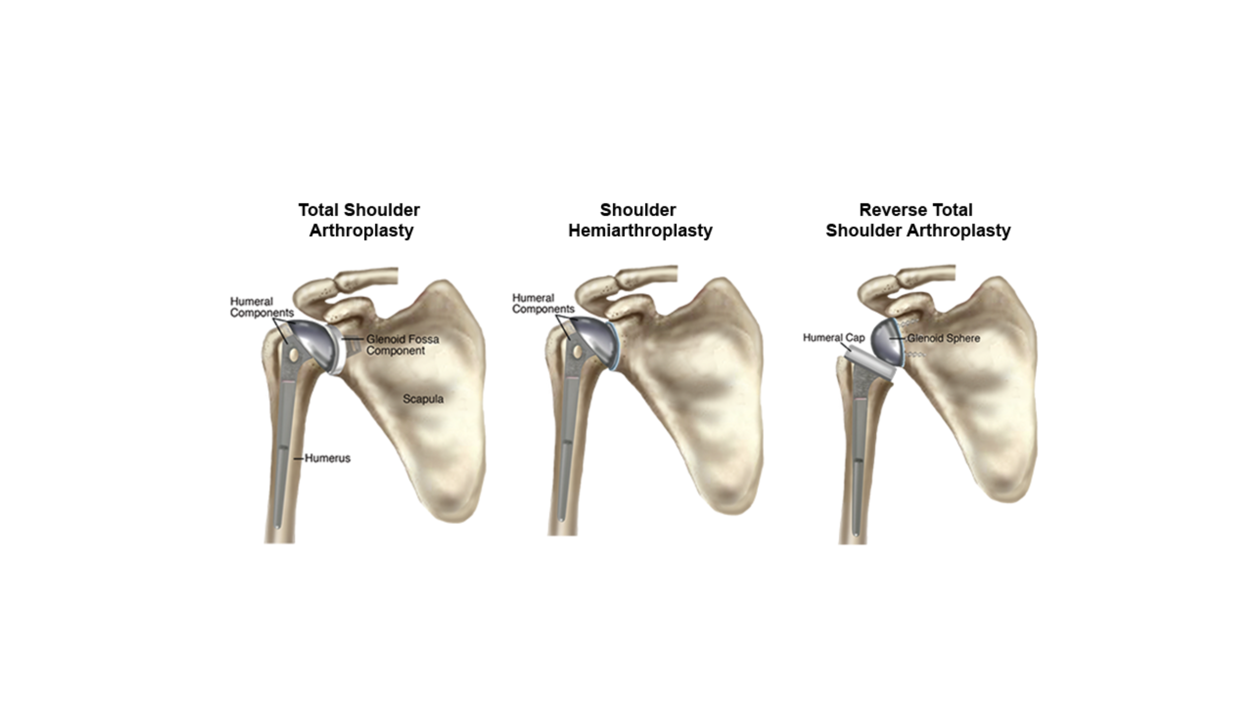 Types of Shoulder Replacement