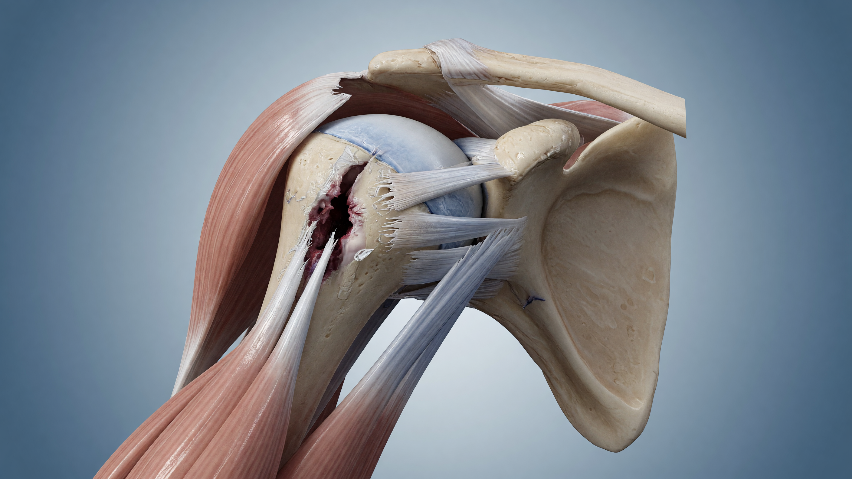 Illustration showing rotator cuff tear causes in a human shoulder joint
