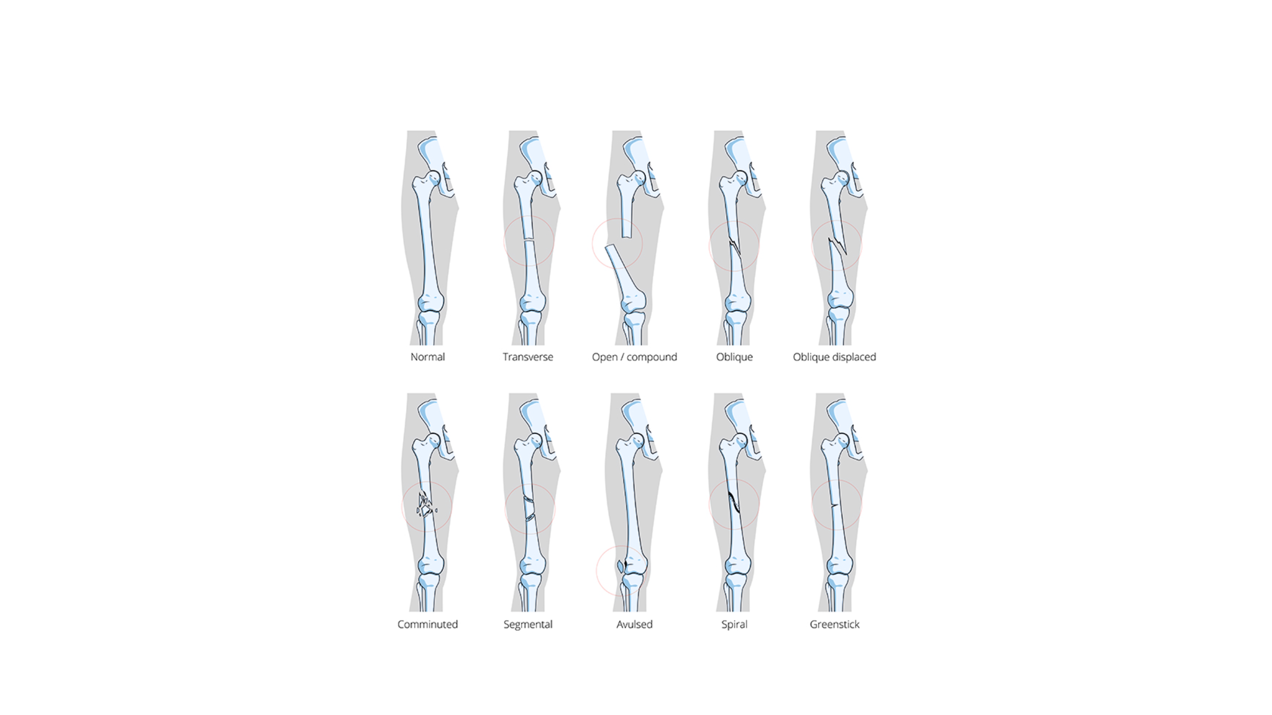 Types of Bone Fractures