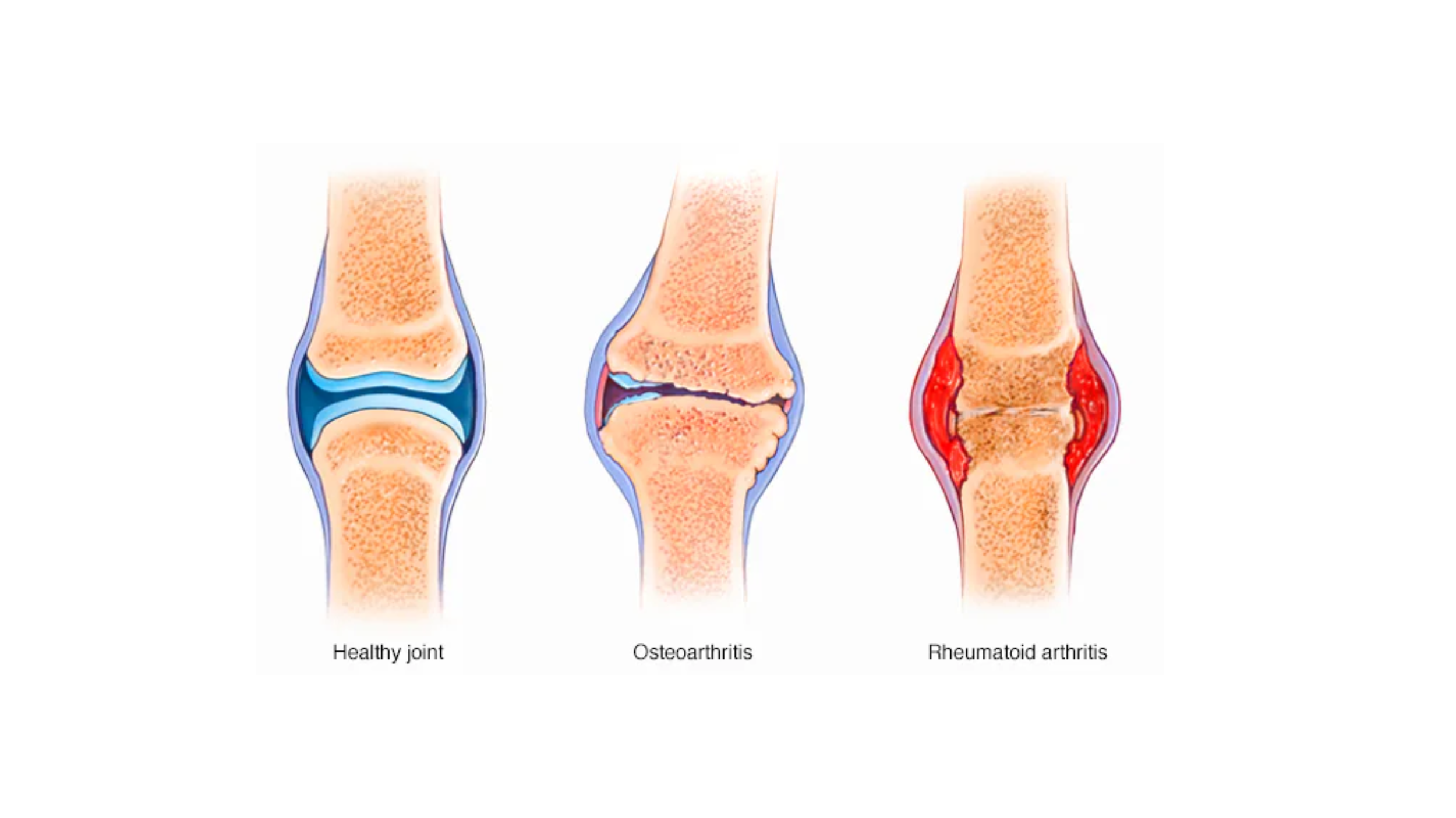 Osteoarthritis vs Rheumatoid Arthritis