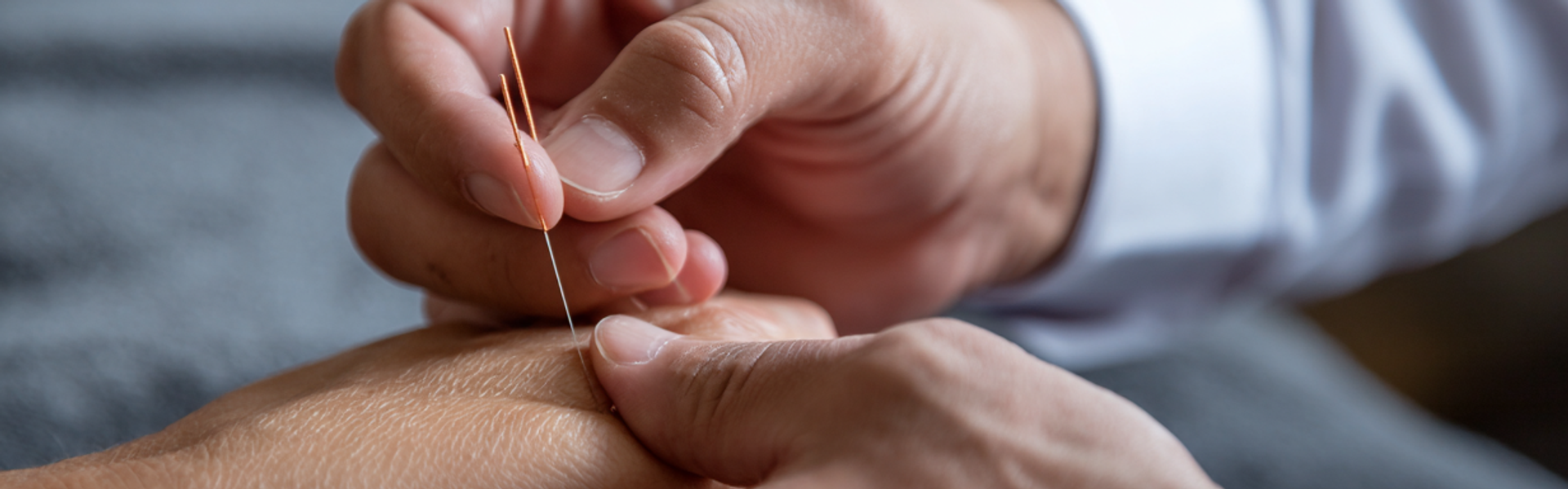 Acupuncture on hand
