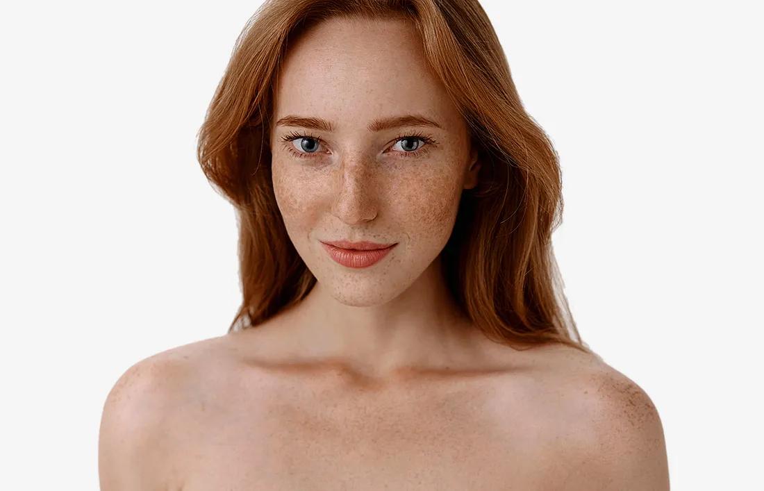 Hyperpigmentation in woman