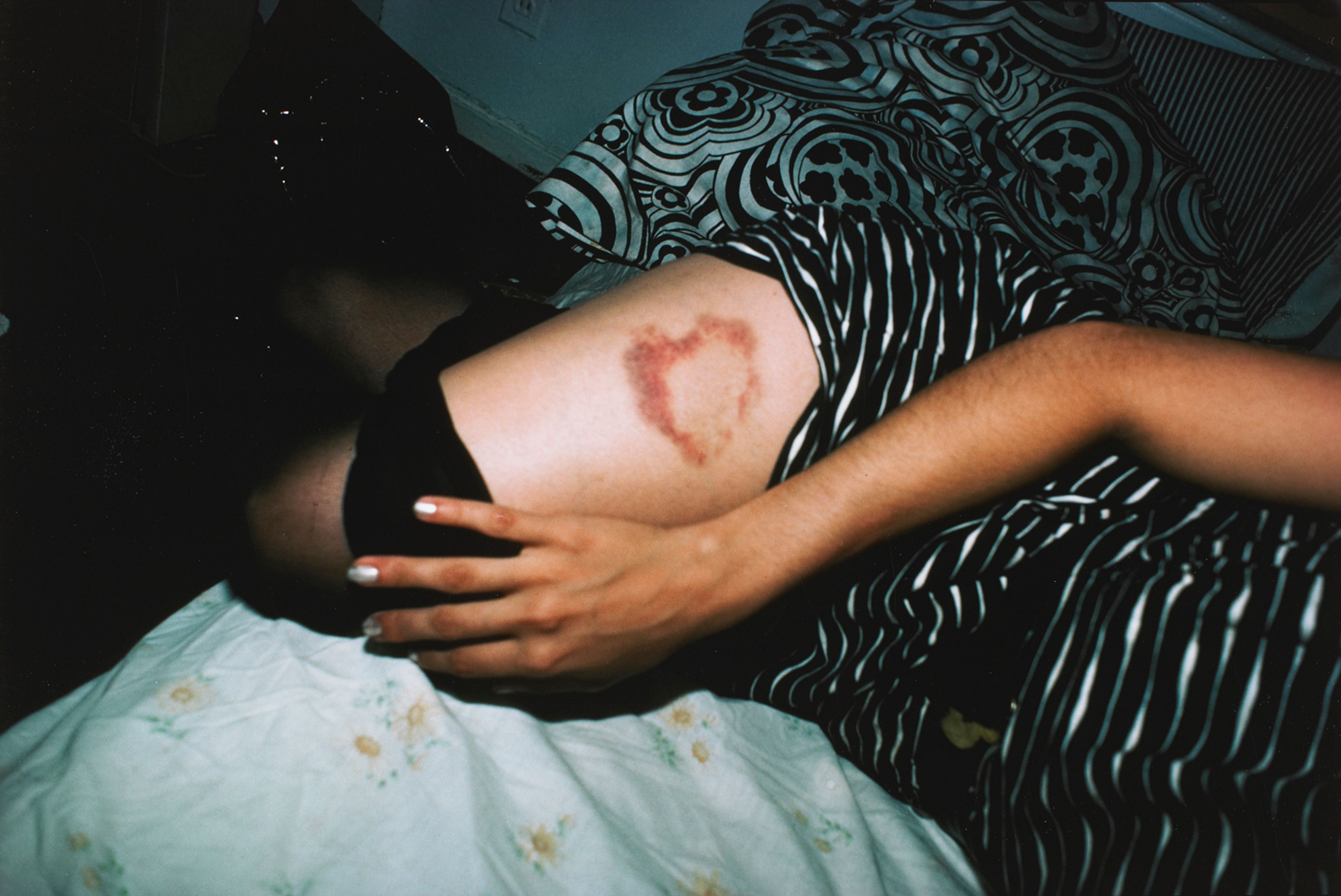 Heart-shaped bruise, New York City