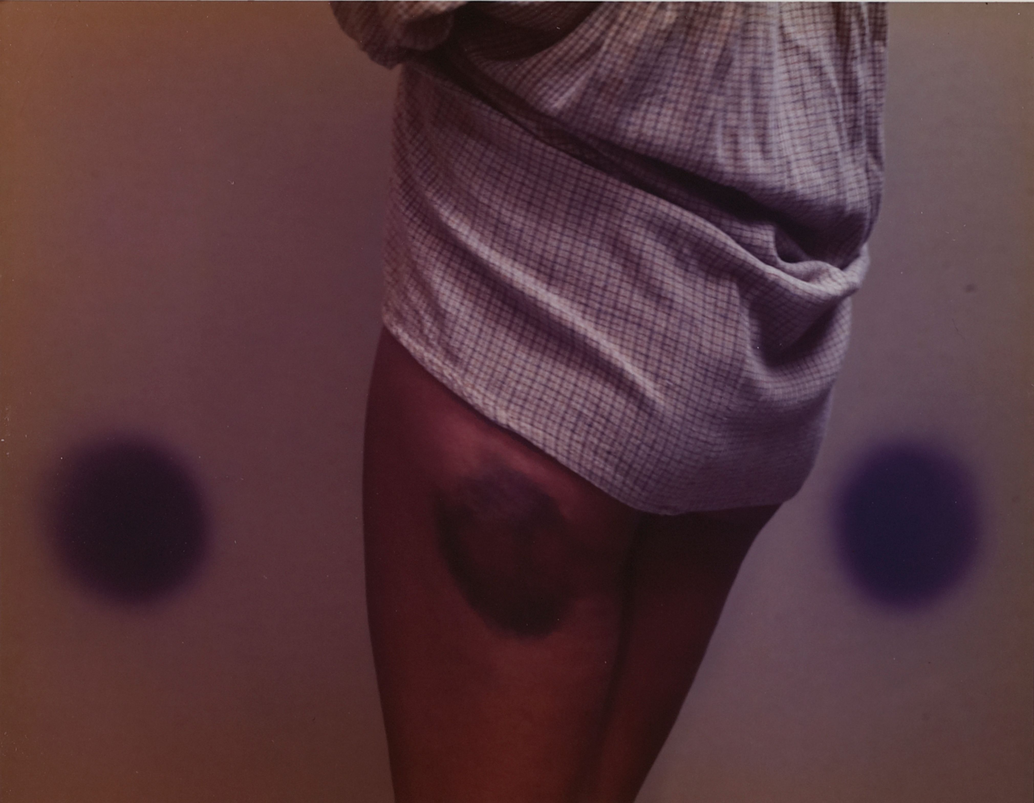 Bonnie’s Bruise, Buffalo, NY