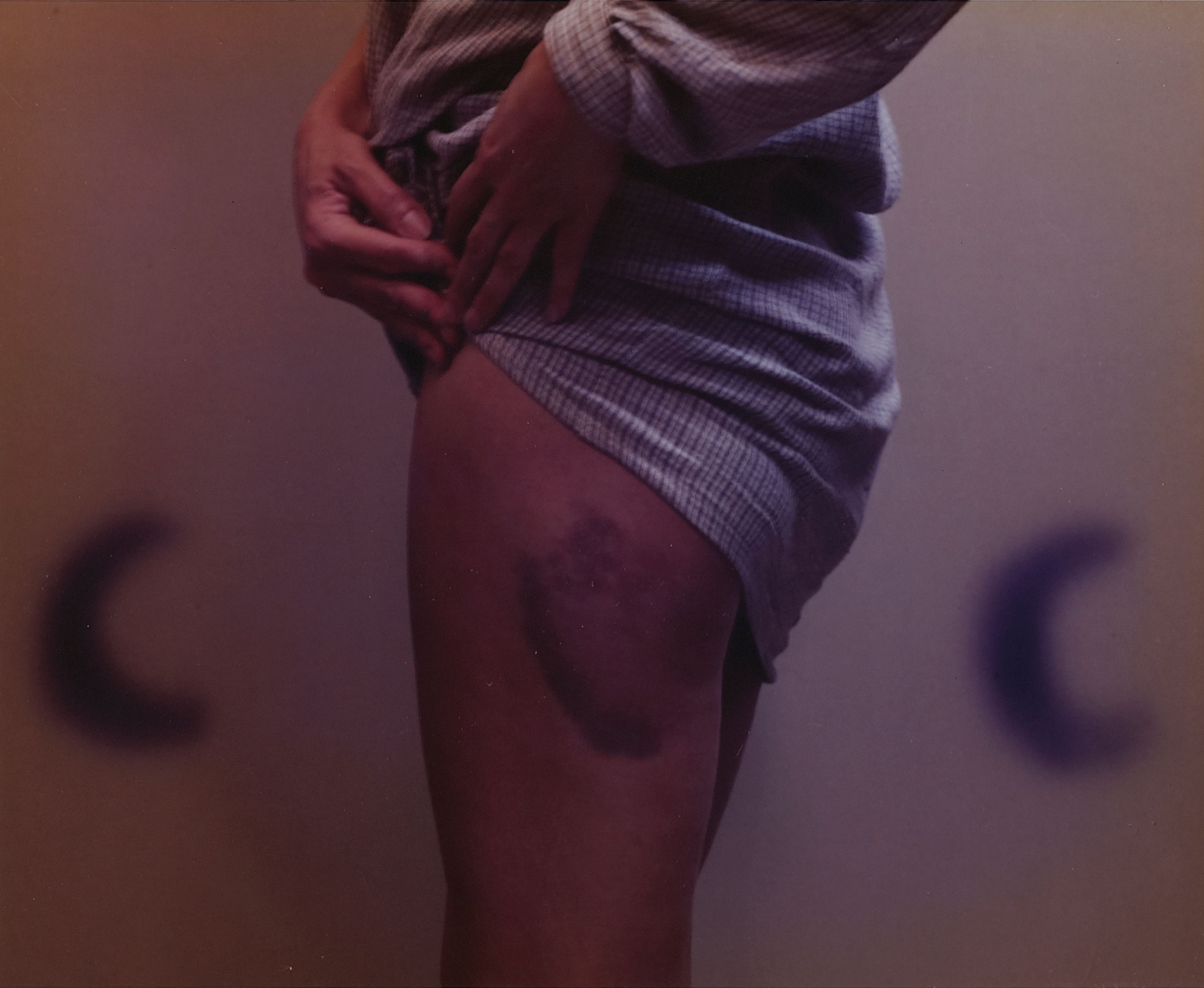 Bonnie’s Bruise (Later Version), Buffalo, NY