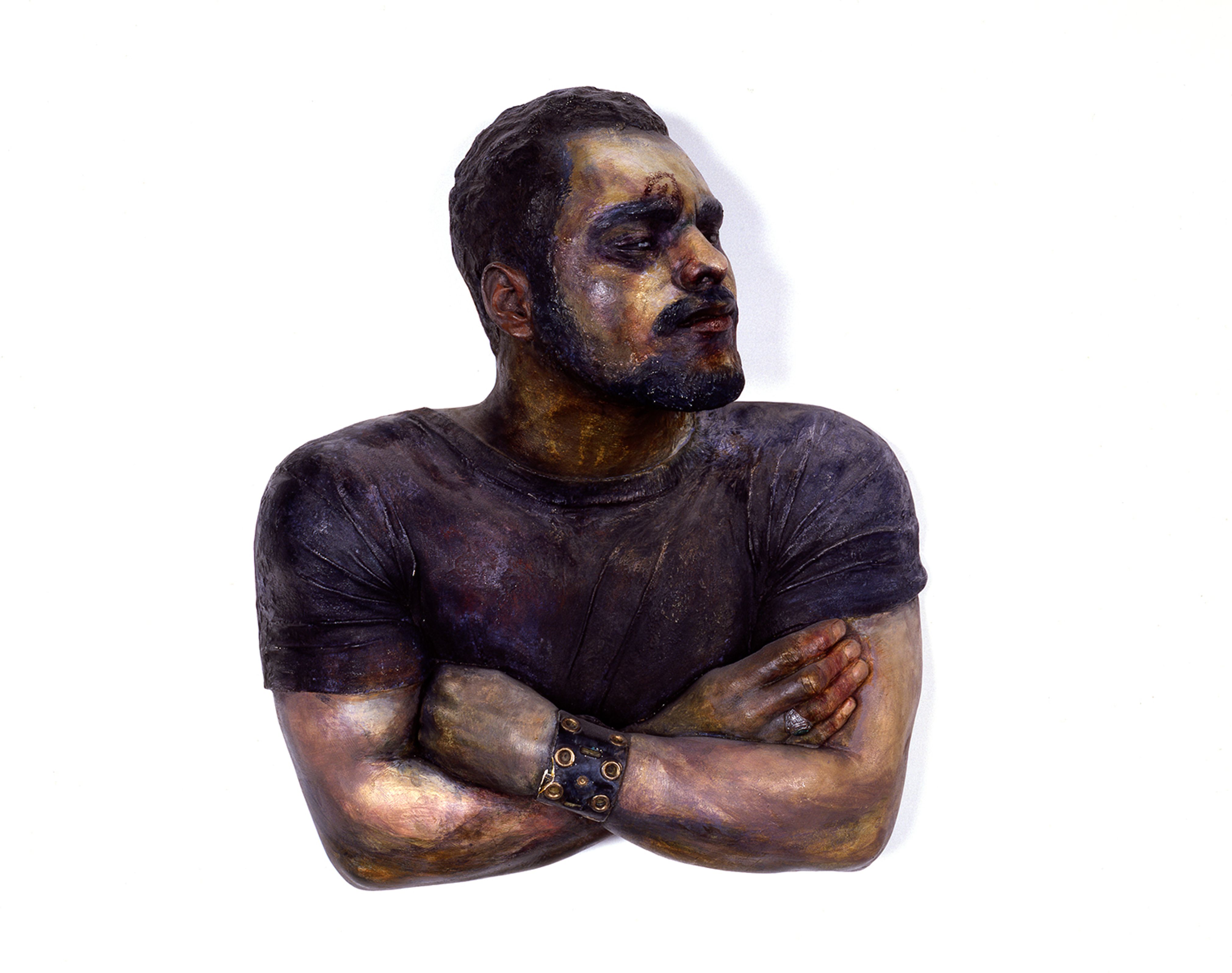 Luis with Bite in Forehead