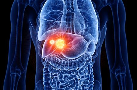 tumors in a liver