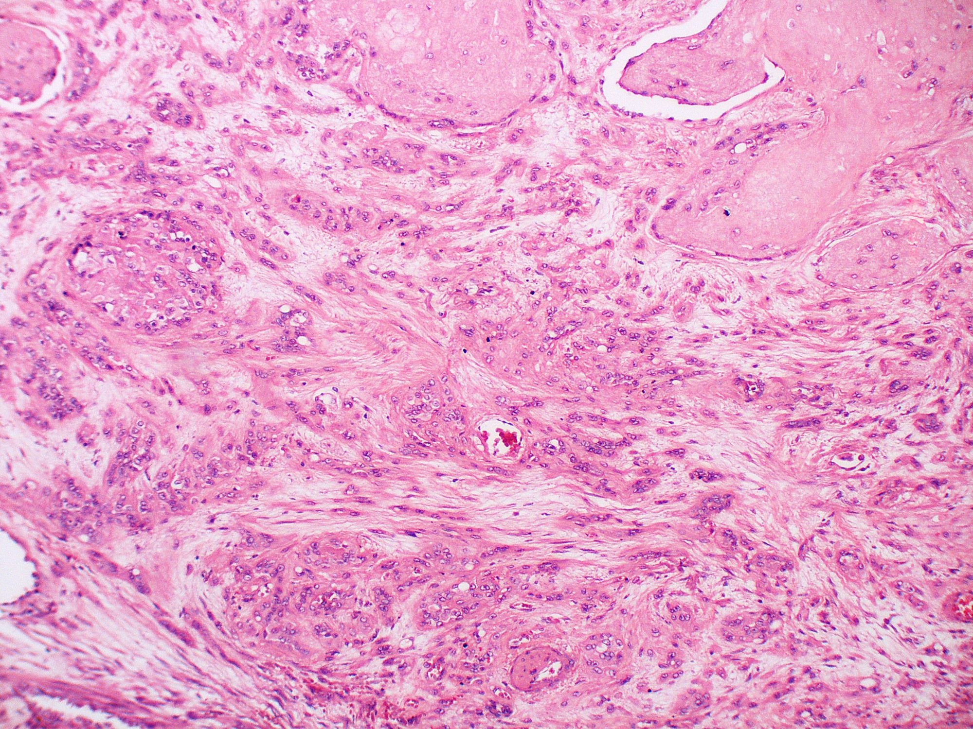 A close look at Epithelioid hemangioendothelioma from a microscope