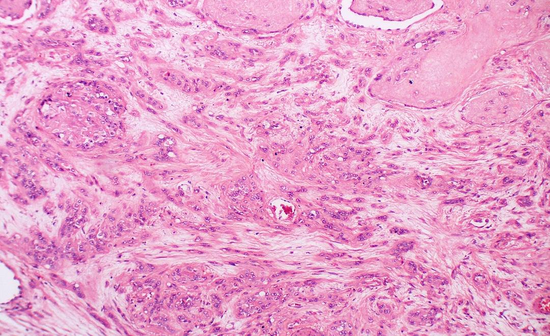 EHE cells