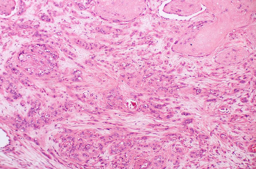 A close look at Epithelioid hemangioendothelioma from a microscope