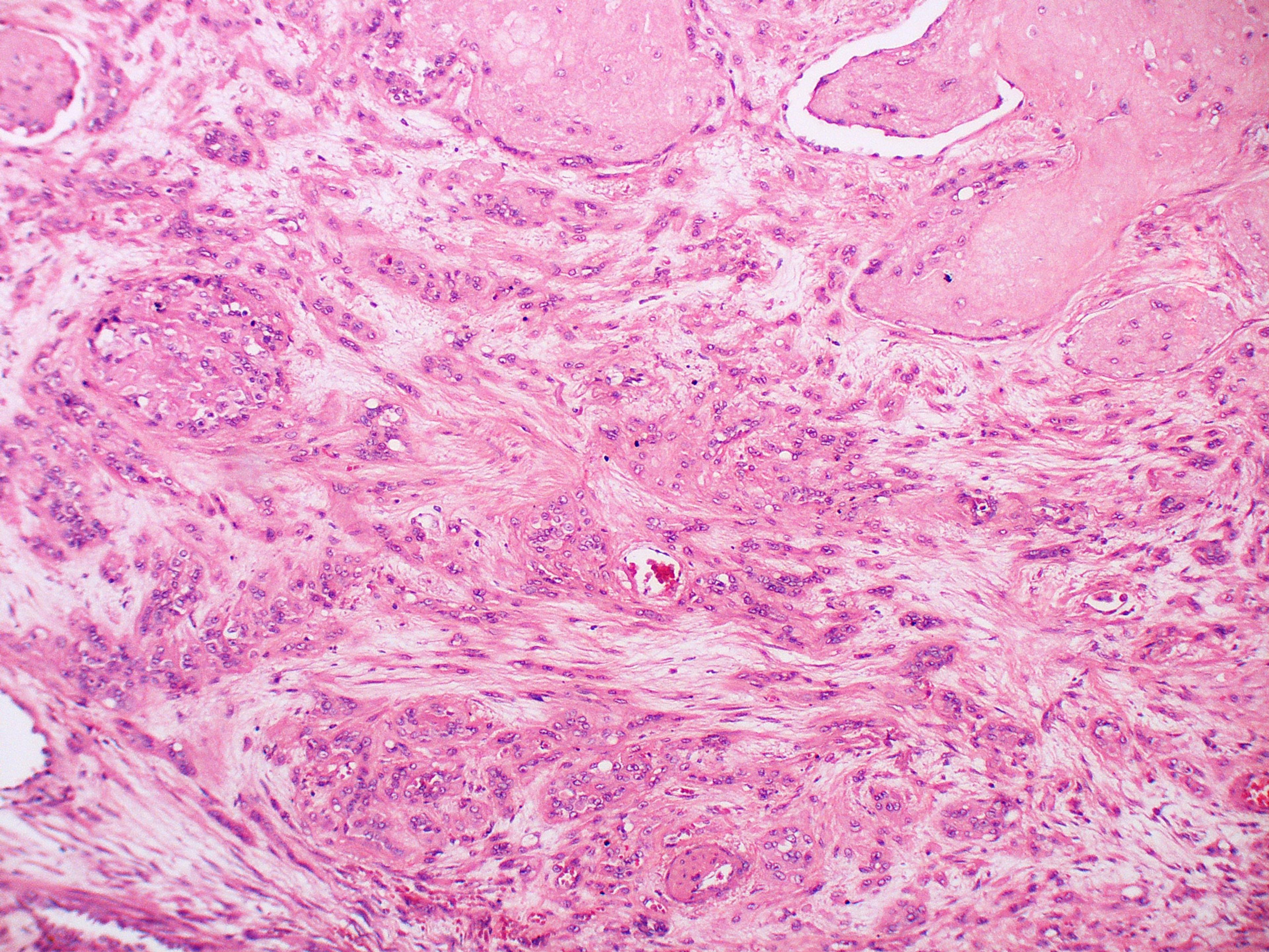 EHE cells