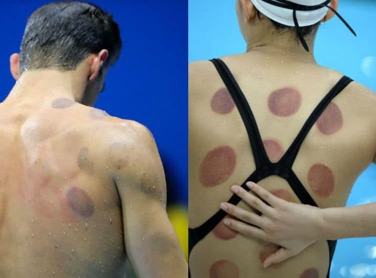  Traitement avec ventouses : une approche efficace pour soulager la douleur et améliorer la circulation