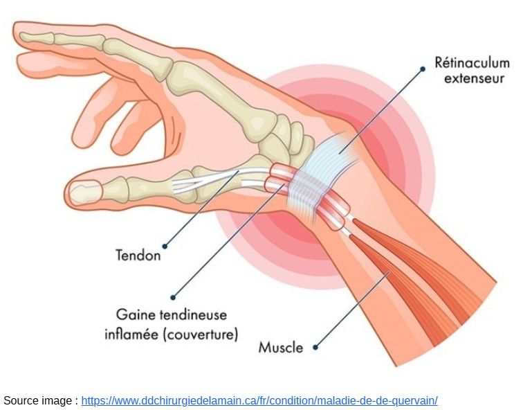 Douleur au pouce : Comprendre la ténosynovite de De Quervain