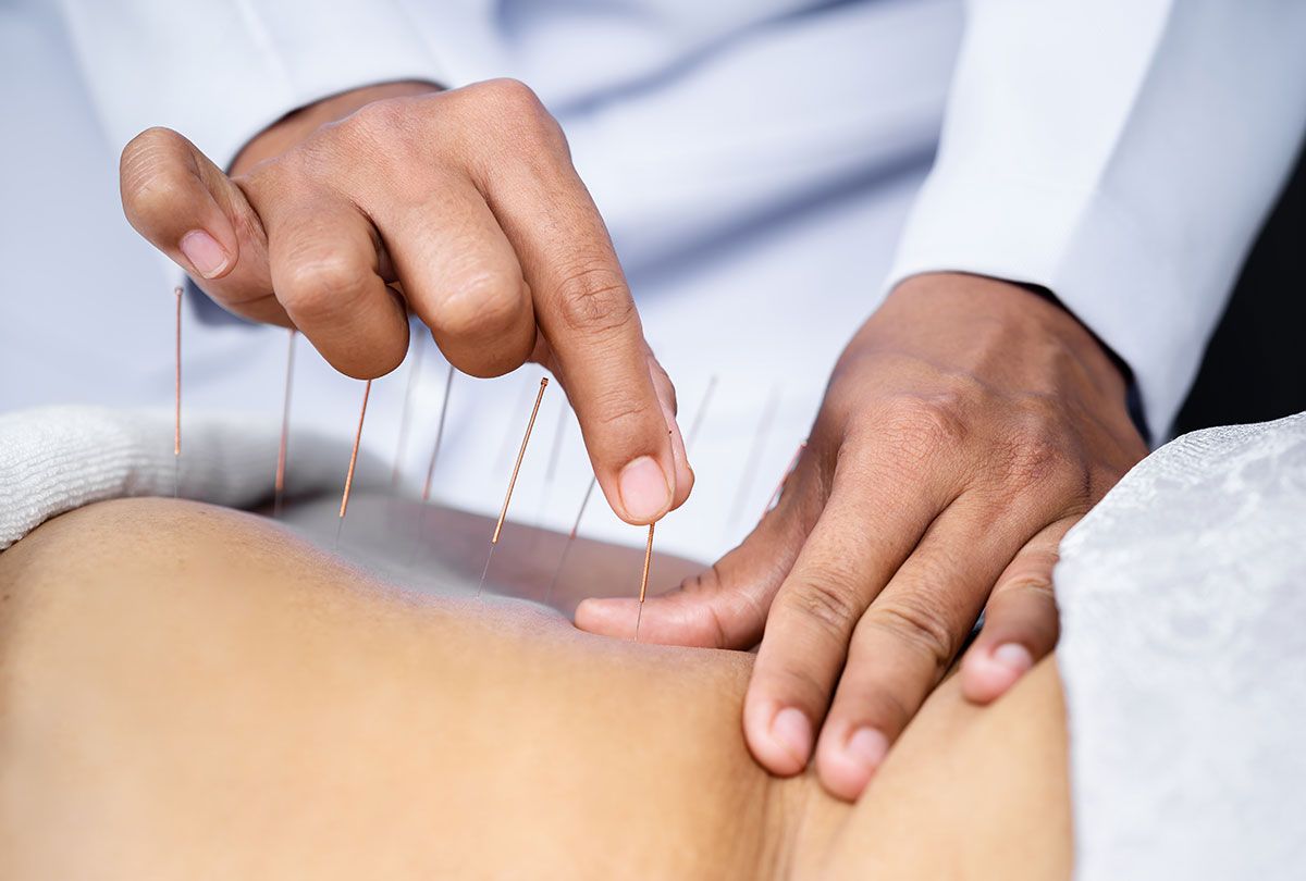 Acupuncture