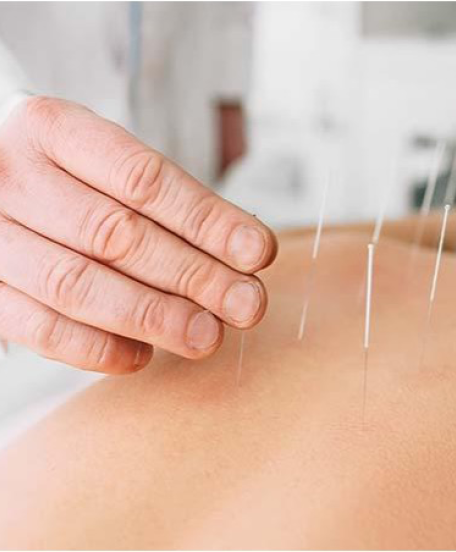 Qu’est‑ce que l’acupuncture et comment peut‑elle améliorer votre santé ?