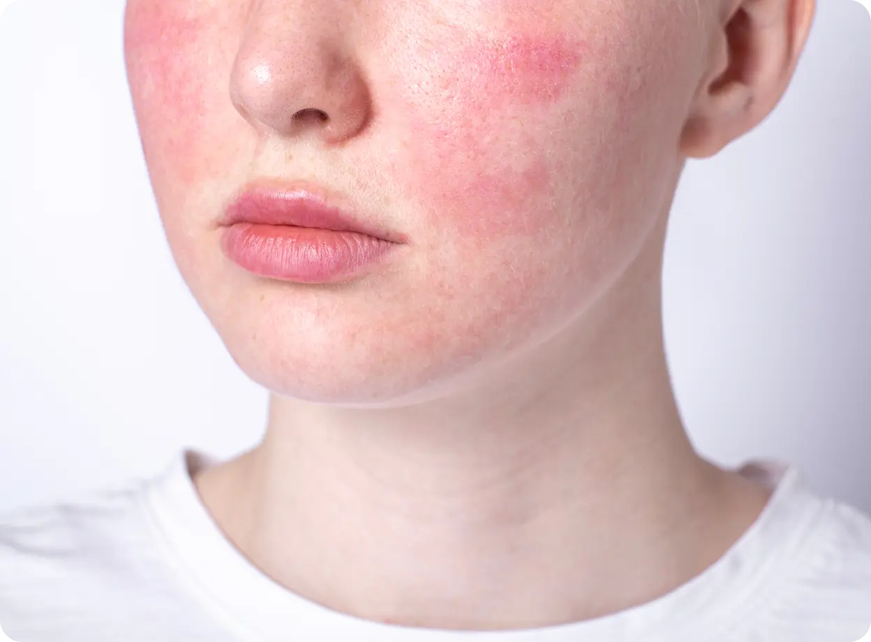 Rosacea treatment prescription online Ireland