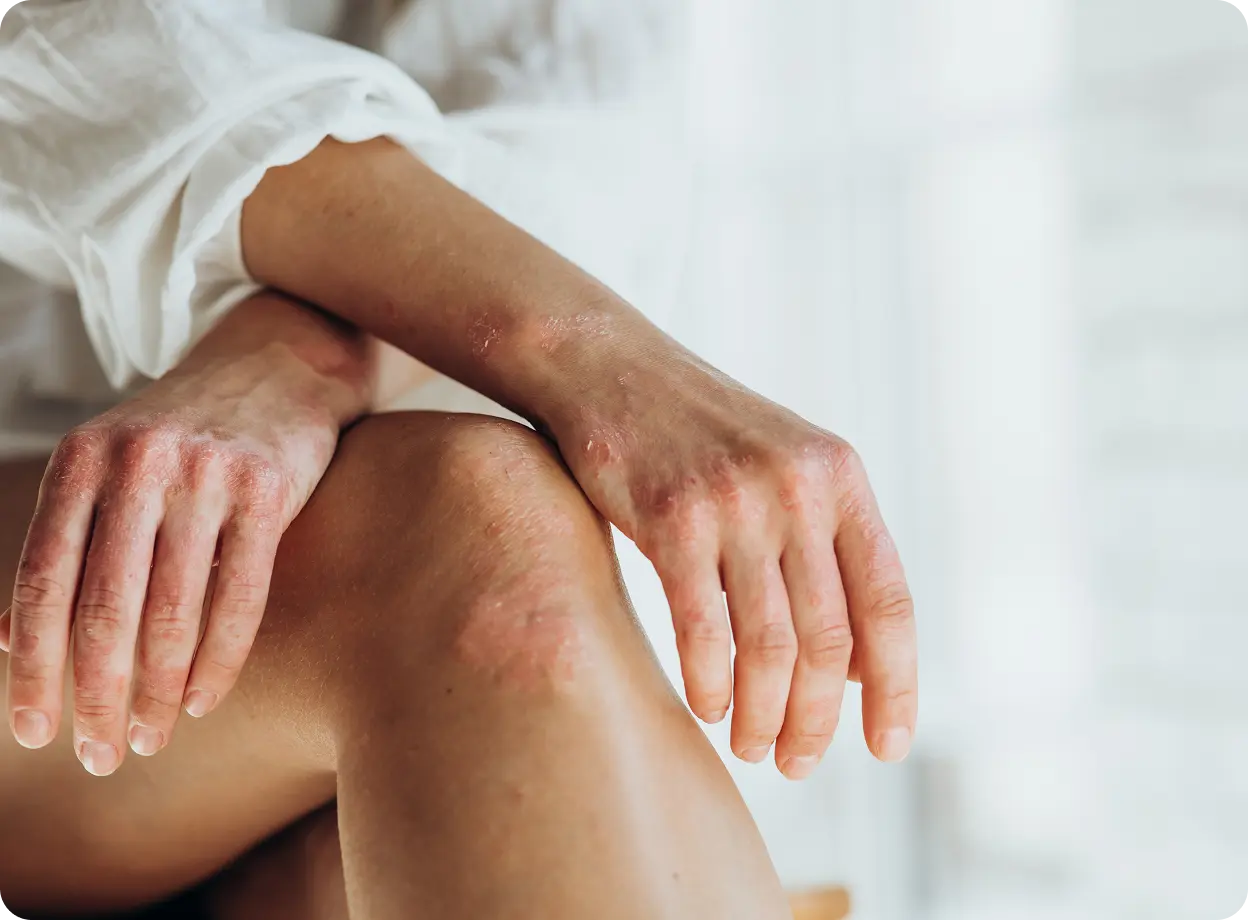 Psoriasis treatment prescription online Ireland