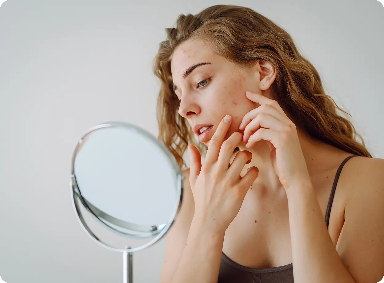 Acne treatment prescription online Ireland