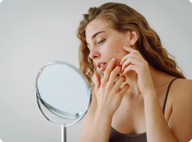 Acne treatment prescription online Ireland