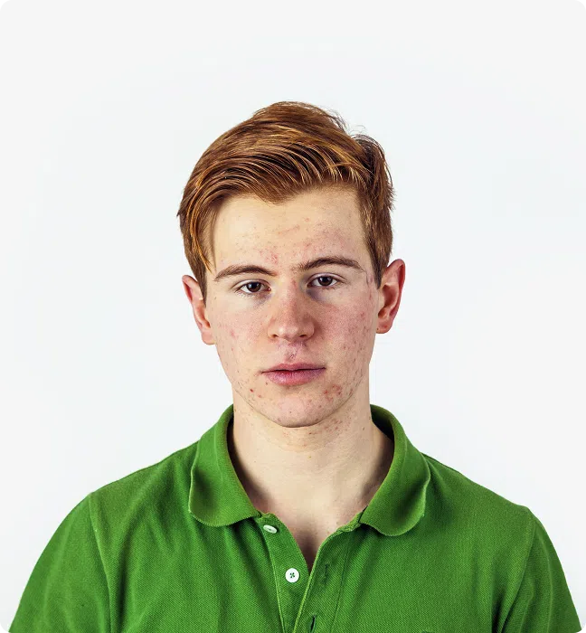 Acne Treatment Ireland, Topical & Oral Prescriptions Online, What Causes Acne