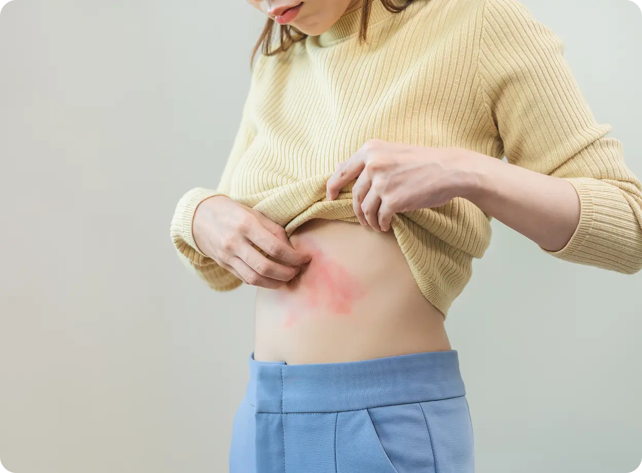 Shingles treatment online Ireland