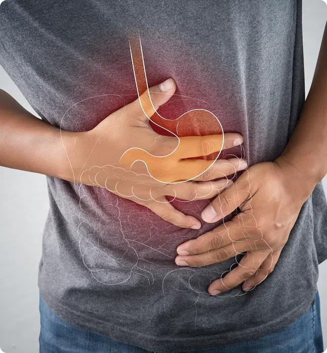 Acid Reflux (GERD) Treatment Online Ireland, What is acid reflux GERD