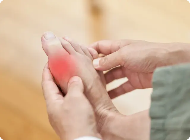 Gout treatment prescription online Ireland