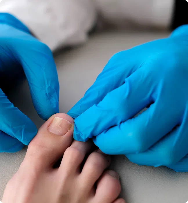 Fungal nail Infection treatment online Ireland, Get rid of stubborn nail fungus quickly