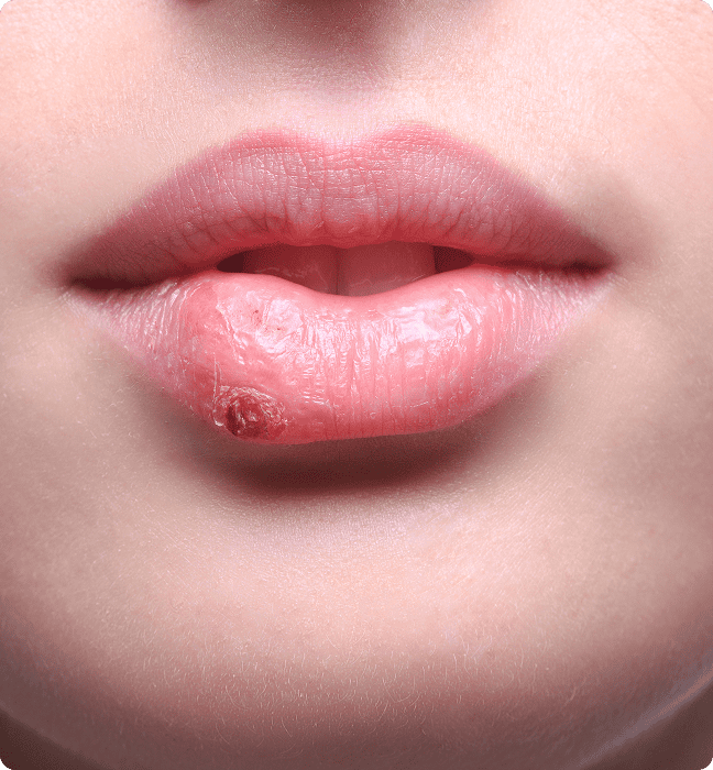 What is a Cold Sore?