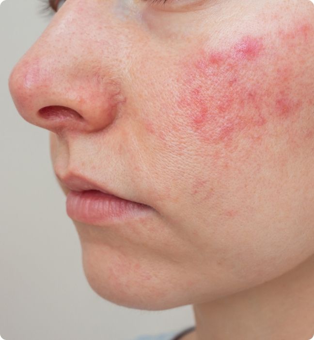 Rosacea Triggers & Symptoms
