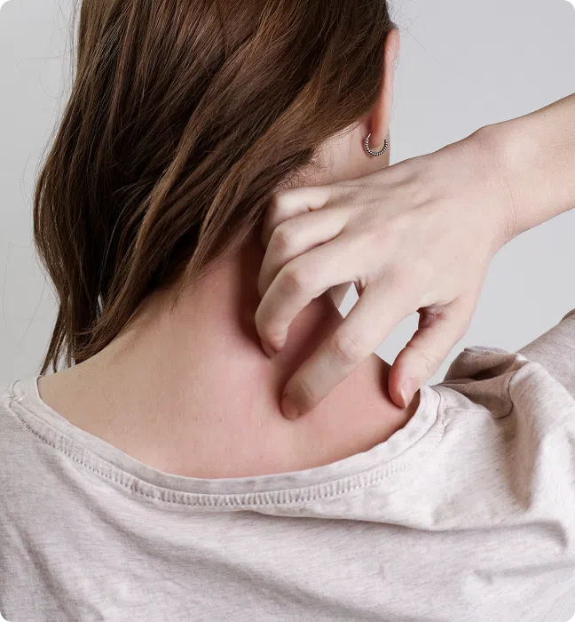 Shingles Treatment Online in Ireland, What is Shingles