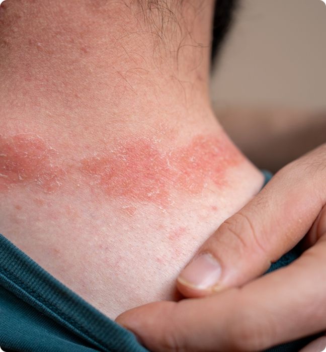 Common Types of Eczema