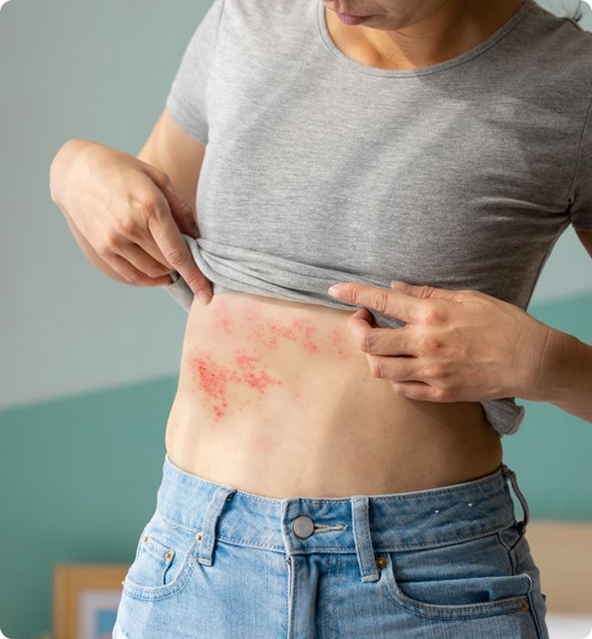 Eczema Treatments Available Through smartscripts.ie