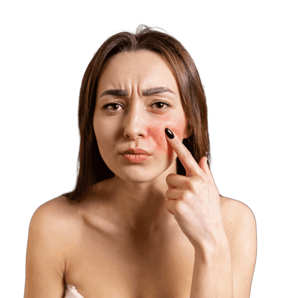 Rosacea Treatment treatment information - SmartScripts Ireland