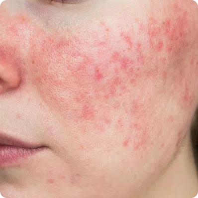 Acne Treatment Ireland, Topical & Oral Prescriptions Online, Acne Treatments We Prescribe