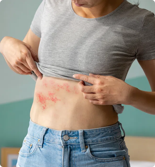Shingles Treatment Online in Ireland, Get Fast Relief From Shingles Pain and Discomfort