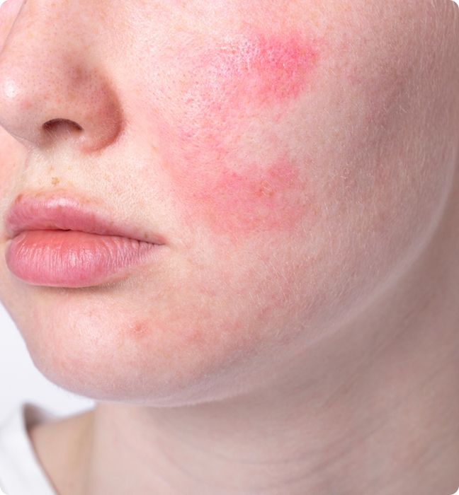 Understanding Rosacea