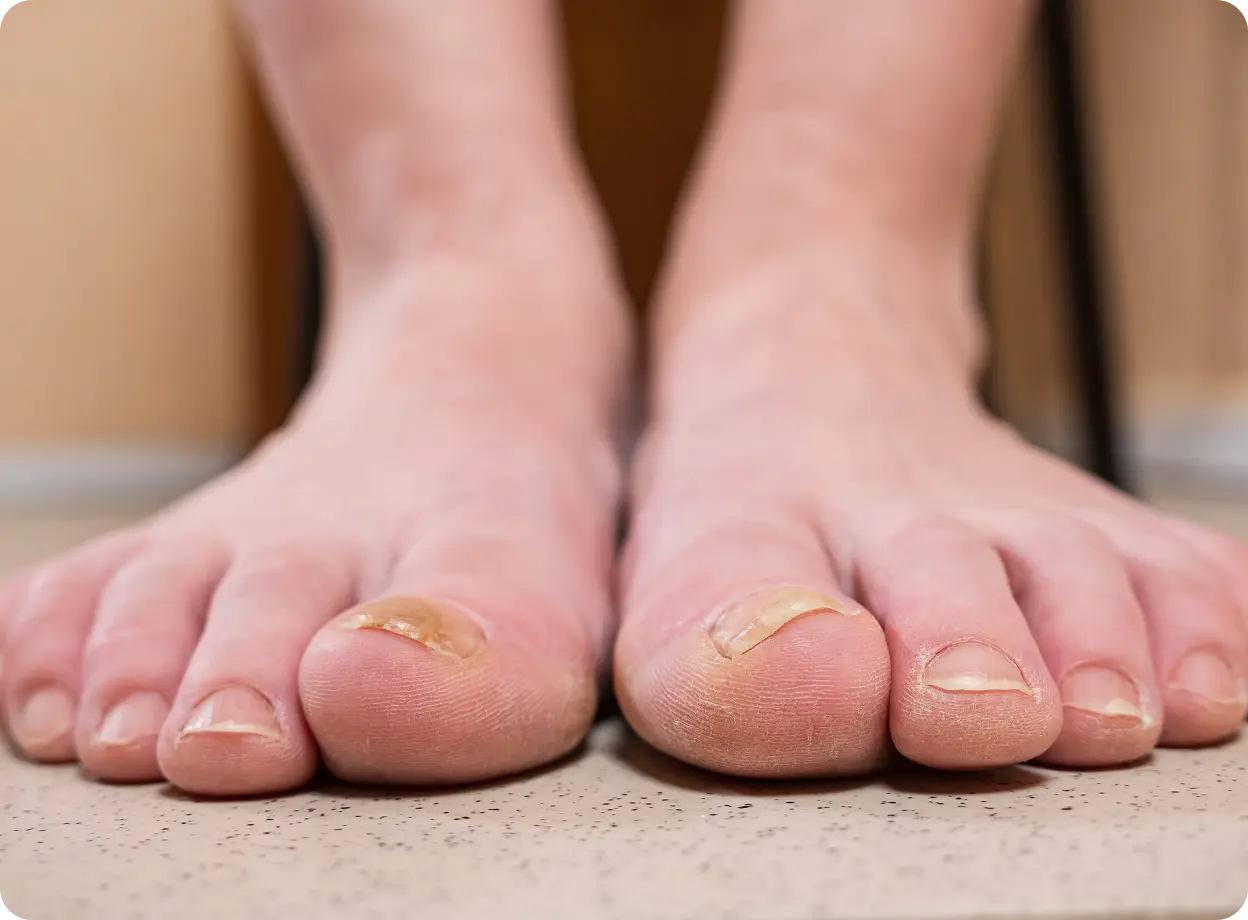 Fungal nail infection treatment online Ireland