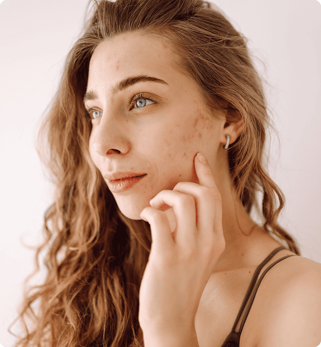 Acne Treatment Ireland, Topical & Oral Prescriptions Online, Struggling with Acne